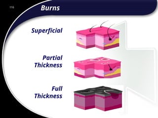 116
Burns
Superficial
Partial
Thickness
Full
Thickness
116
© 2002 Abertay Nationwide Training
 