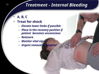 77
Treatment - Internal Bleeding
• A, B, C
• Treat for shock
– Elevate lower limbs if possible
– Place in the recovery position if
patient becomes unconscious
– Reassure
– Monitor vital signs
– Urgent removal to hospital
77
© 2002 Abertay Nationwide Training
 