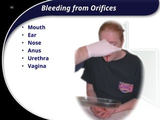 80
Bleeding from Orifices
• Mouth
• Ear
• Nose
• Anus
• Urethra
• Vagina
80
© 2002 Abertay Nationwide Training
 