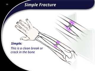 99
Simple:
This is a clean break or
crack in the bone
Simple Fracture
99
© 2002 Abertay Nationwide Training
 