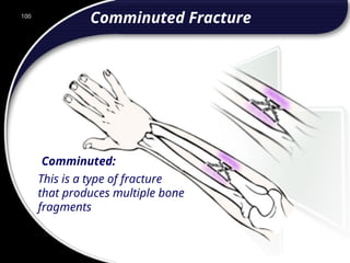 100
Comminuted:
This is a type of fracture
that produces multiple bone
fragments
Comminuted Fracture
100
© 2002 Abertay Nationwide Training
 