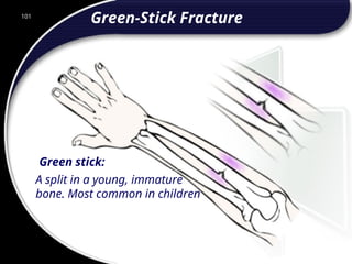 101
Green stick:
A split in a young, immature
bone. Most common in children
Green-Stick Fracture
101
© 2002 Abertay Nationwide Training
 