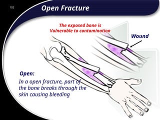 102
Open:
In a open fracture, part of
the bone breaks through the
skin causing bleeding
The exposed bone is
Vulnerable to contamination
Wound
Open Fracture
102
© 2002 Abertay Nationwide Training
 