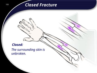 103
Closed:
The surrounding skin is
unbroken.
Closed Fracture
103
© 2002 Abertay Nationwide Training
 