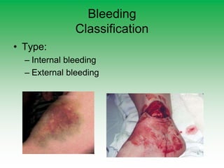 Bleeding
Classification
• Type:
– Internal bleeding
– External bleeding
 