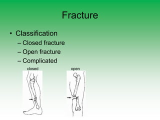 Fracture
• Classification
– Closed fracture
– Open fracture
– Complicated
closed open
 