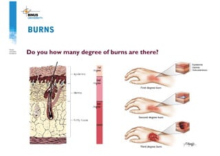 BURNS
Do you how many degree of burns are there?
 
