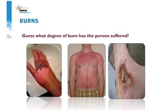 BURNS
Guess what degree of burn has the person suffered?
 