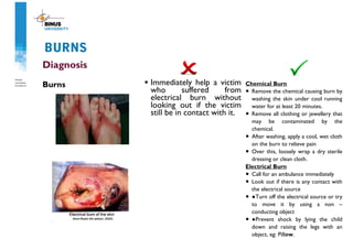 BURNS
Diagnosis
Burns • Immediately help a victim
who suffered from
electrical burn without
looking out if the victim
still be in contact with it.
Chemical Burn
• Remove the chemical causing burn by
washing the skin under cool running
water for at least 20 minutes.
• Remove all clothing or jewellery that
may be contaminated by the
chemical.
• After washing, apply a cool, wet cloth
on the burn to relieve pain
• Over this, loosely wrap a dry sterile
dressing or clean cloth.
Electrical Burn
• Call for an ambulance immediately
• Look out if there is any contact with
the electrical source
• ●Turn off the electrical source or try
to move it by using a non –
conducting object
• ●Prevent shock by lying the child
down and raising the legs with an
object, eg: Pillow.
 