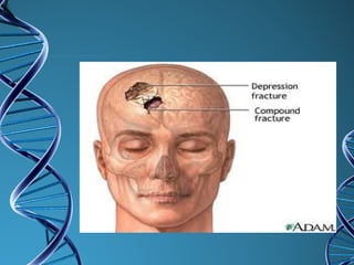 First aid for fracture | PPT