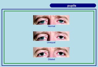 pupils
Normal
Unequal
Dilated
 