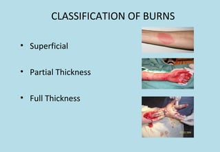 CLASSIFICATION OF BURNS
• Superficial
• Partial Thickness
• Full Thickness
 