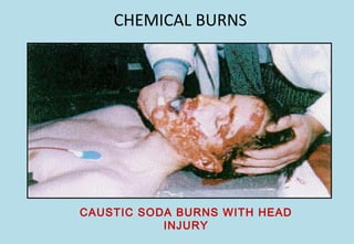CHEMICAL BURNS
CAUSTIC SODA BURNS WITH HEAD
INJURY
 
