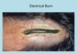 Electrical Burn
 