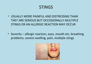 STINGS
• USUALLY MORE PAINFUL AND DISTRESSING THAN
THEY ARE SERIOUS BUT OCCOSIONALLY MULTIPLE
STINGS OR AN ALLERGIC REACTION MAY OCCUR
• Severity – allergic reaction, eyes, mouth etc, breathing
problems, severe swelling, pain, multiple stings
 