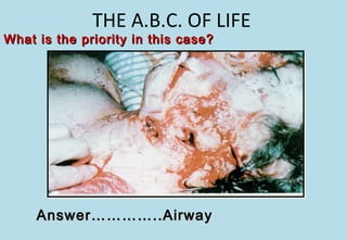 THE A.B.C. OF LIFE
What is the priority in this case?What is the priority in this case?
Answer…………..AirwayAnswer…………..Airway
 