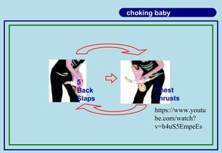 choking baby
5
Back
Slaps
5
Chest
Thrusts
https://www.youtu
be.com/watch?
v=h4uS5EmpeEs
 
