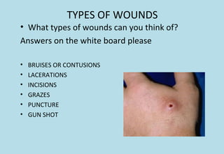 TYPES OF WOUNDS
• What types of wounds can you think of?
Answers on the white board please
• BRUISES OR CONTUSIONS
• LACERATIONS
• INCISIONS
• GRAZES
• PUNCTURE
• GUN SHOT
 