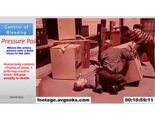 Control of
Bleeding
Control of
Bleeding
Temporal
Facial
Carotid
Sub-clavian
Brachial
Radial
Ulnar
Femoral
Popliteal
Pedal
Where the artery
passes over a bone
close to the skin
Pressure Points
Human body contains
≈10 pints of blood, 1
pints may result in
shock, 5-6 pint
usually in death.
Veins
Capillary
Steady flow
Oozing
Artery
Types of Bleeding
Direct Pressure Elevation
Cold Applications
Control of Bleeding
Spurting
Pressure bandage
Internal Injuries
Until emergency help arrives, try to control
bleeding. If possible, first put on rubber or
latex gloves before touching any blood. If
these are not available, a clean plastic bag
can be used to cover your hands. It is
important not to come in contact with
blood because of the health risks.
Do NOT breathe, blow, or cough on the burn.Internal InjuryInternal Injury
 