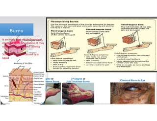 1st Degree or
Superficial Burns
2nd Degree or
Partial Thickness Burns
3rd Degree or
Full Thickness Burns
BurnsBurns
Chemical Burns to Eye
Is an injury that results from heat,
chemical agent or radiation. It may
vary in: depth, size and severity
Scalds – is a burn caused by a
liquid
 