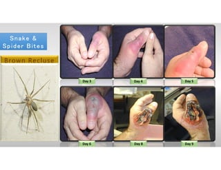 Day 3 Day 4 Day 5
Day 6 Day 8 Day 9
Brown Recluse
Snake &
Spider Bites
Snake &
Spider Bites
 