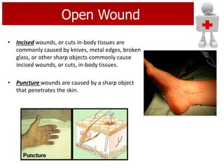 • Incised wounds, or cuts in-body tissues are
commonly caused by knives, metal edges, broken
glass, or other sharp objects commonly cause
incised wounds, or cuts, in-body tissues.
• Puncture wounds are caused by a sharp object
that penetrates the skin.
Open Wound
 