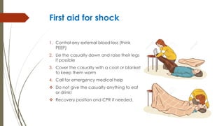 First aid for shock
1. Control any external blood loss (think
PEEP)
2. Lie the casualty down and raise their legs
if possible
3. Cover the casualty with a coat or blanket
to keep them warm
4. Call for emergency medical help
 Do not give the casualty anything to eat
or drink!
 Recovery position and CPR if needed.
 