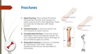 Fractures
1. Open fracture: This is where the bone
has pierced the skin and caused an
open wound which may bleeding. There
is a high risk of infection with these
injuries
2. Closed fracture: A fracture which has
not caused an open wound
3. Complicated fracture: A fracture which
damages nerves and blood vessels, this
can cause permanent nerve damage or
loss of blood supply to a limb.
4. Greenstick fracture: Common in children
as their bone’s are more “bendy”,
therefore their bones are less likely to
fully break.
 