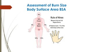 Assessment of Burn Size
Body Surface Area BSA
 