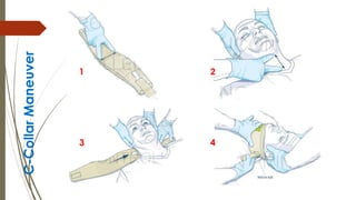 C-Collar
Maneuver
1 2
3 4
 