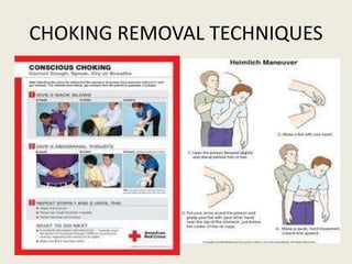 CHOKING REMOVAL TECHNIQUES
 