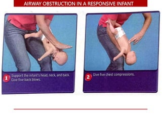 AIRWAY OBSTRUCTION IN A RESPONSIVE INFANT
 