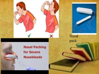 Nasal
pack
 