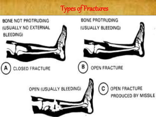 Types of Fractures
 