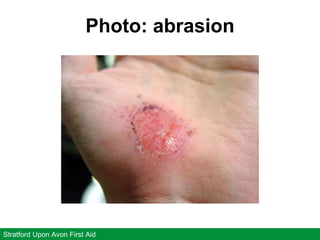 Photo: abrasion
Stratford Upon Avon First Aid
 