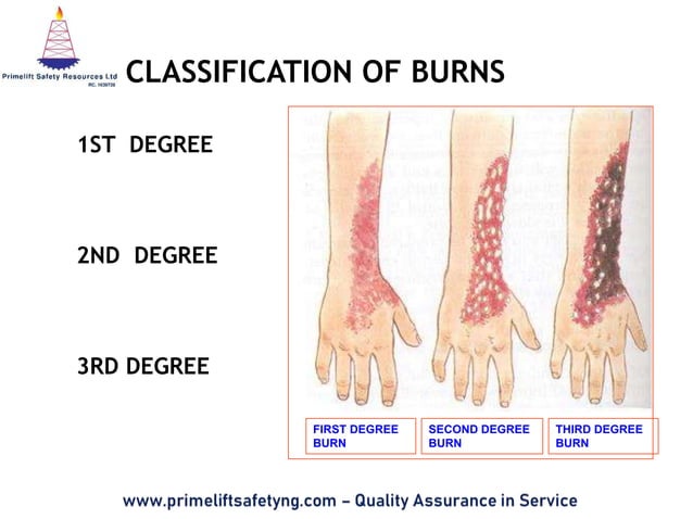 First Aid for Burns.pptx | First Aid | Injuries