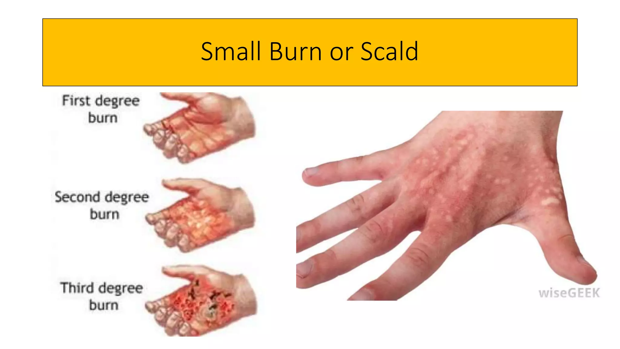 first-aid-for-common-injuries-pptx