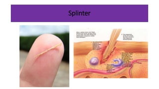 Subdermal Splinter First aid for common injuries | PPTX