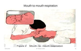 Mouth to mouth respiration
8/26/2023 BY: MEAZA LEMA 62
 