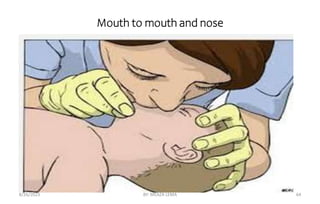 Mouth to mouth and nose
8/26/2023 BY: MEAZA LEMA 64
 