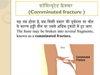 कॉमिन्यूटेड फ्रै क्चर
(Comminuted fracture )
यह तब होता है, जब किसी प्रकार की दुर्घटना या चोट
के कारण हड्डी तीन या उससे अधिक टुकड़ों में टूट जाए
The bone may be broken into several fragments,
known as a comminuted fracture.
 