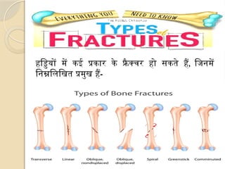 हड्डियों में कई प्रकार के फ्रै क्चर हो सकते हैं, जिनमें
निम्नलिखित प्रमुख हैं-
 