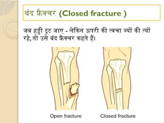 बंद फ्रै क्चर (Closed fracture )
जब हड्डी टूट जाए - लेकिन ऊपरी की त्वचा ज्यों की त्यों
रहे, तो उसे बंद फ्रैक्चर कहते हैं।
 