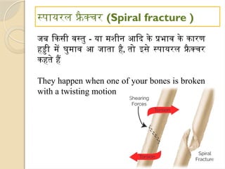 स्पायरल फ्रै क्चर (Spiral fracture )
जब किसी वस्तु - या मशीन आदि के प्रभाव के कारण
हड्डी में घुमाव आ जाता है, तो इसे स्पायरल फ्रैक्चर
कहते हैं
They happen when one of your bones is broken
with a twisting motion
 