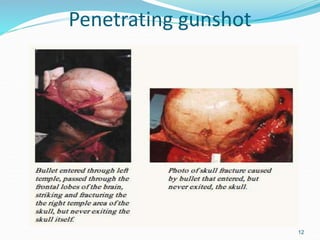 Penetrating gunshot
12
 