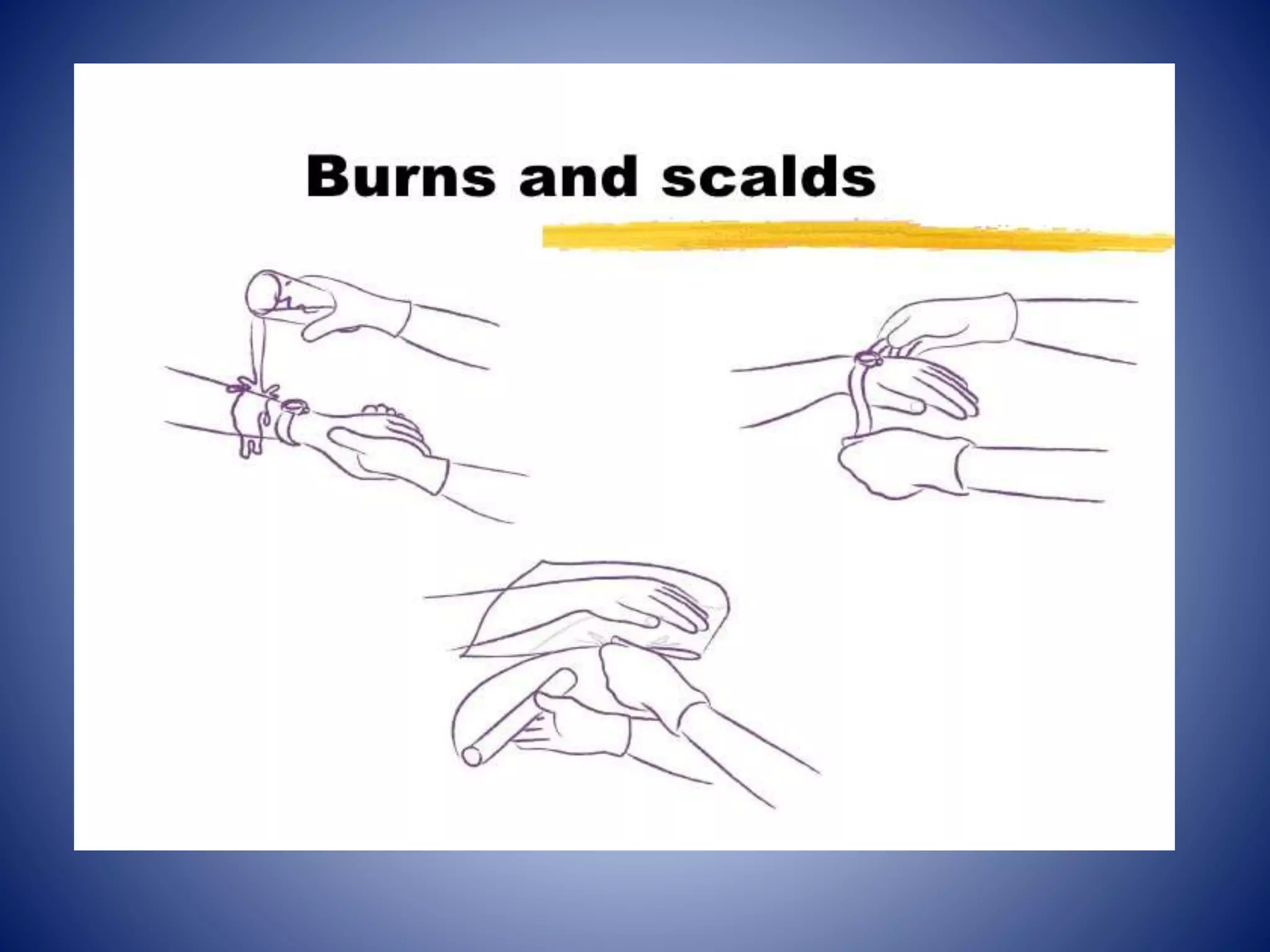 First aid in burns and scalds | PPTX