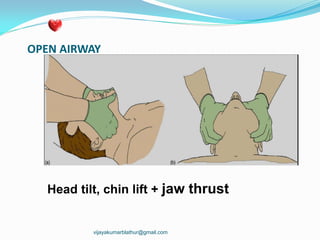 OPEN AIRWAY
Head tilt, chin lift + jaw thrust
vijayakumarblathur@gmail.com
 
