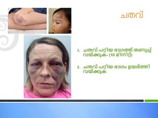 െതവ്
1. ചതവ്് െറ്റിയ ഭാഗ്ത് തണുപ്പ്
വ്യ്ക്കുക- (10 മിനിറ്റ്)
2. ചതവ്് െറ്റിയ ഭാഗ്ം ഉയര്തി
വ്യ്ക്കുക
 