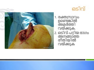 ഒടിവ്
1. രക്തപ്രോവം
ഉചെങ്കില്‍
അമര്‍ത്തി
വ ്ക്കുക.
2. ഒടിവ് രറ്റി ഭോഗ്ം
അനങ്ങോത
രീതി ില്‍
വ ്ക്കുക
 