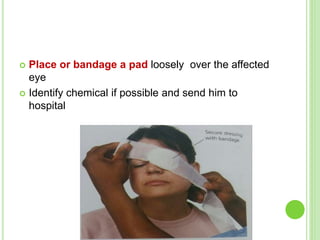 Place or bandage a pad loosely over the affected
eye
 Identify chemical if possible and send him to
hospital
 